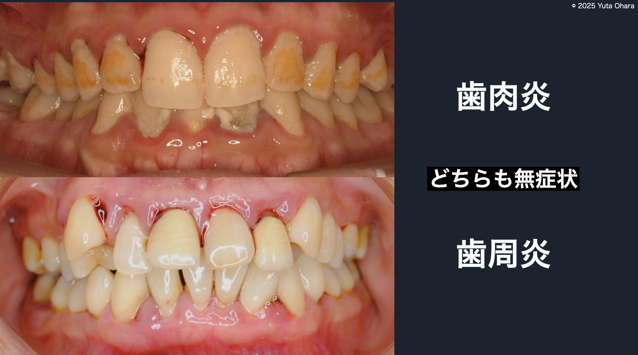 サイレントディジーズ（Silent Disease）