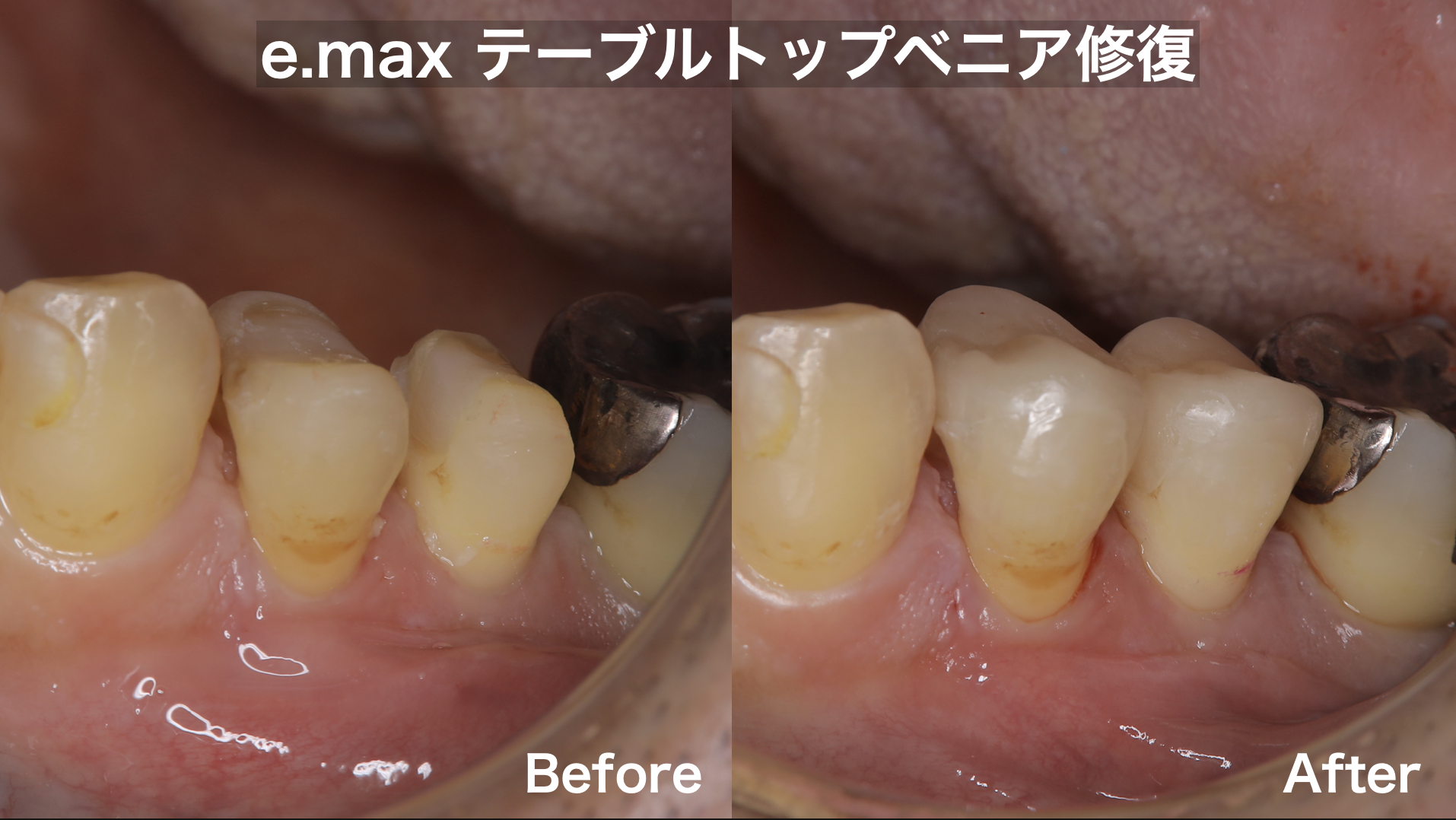 e.max テーブルトップベニア