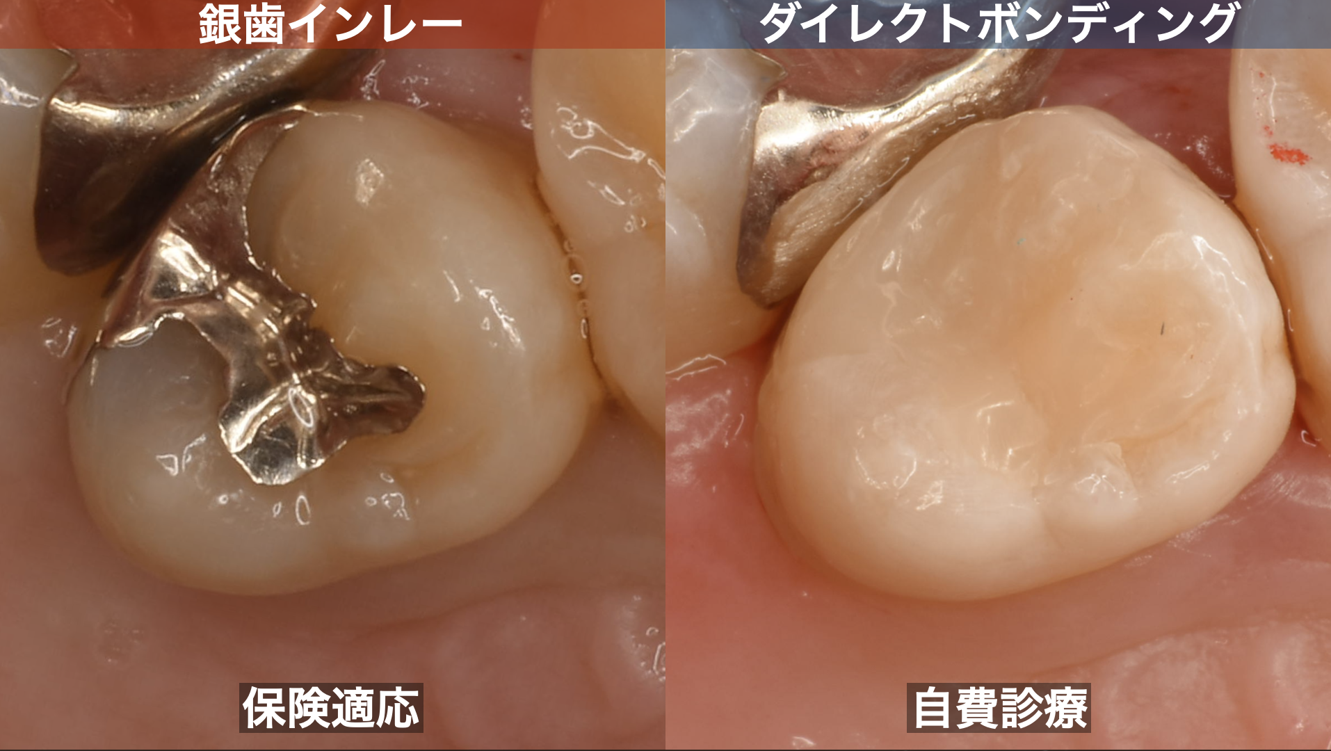 CR/銀歯 保険診療