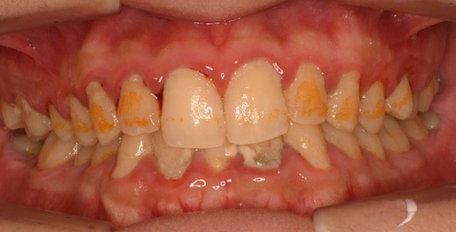 歯肉炎。歯の表面についたプラークが歯グキに感染し、炎症を起こします。