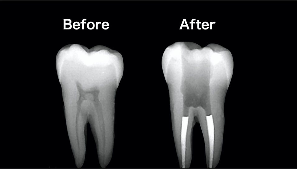 薬剤で根管を充填