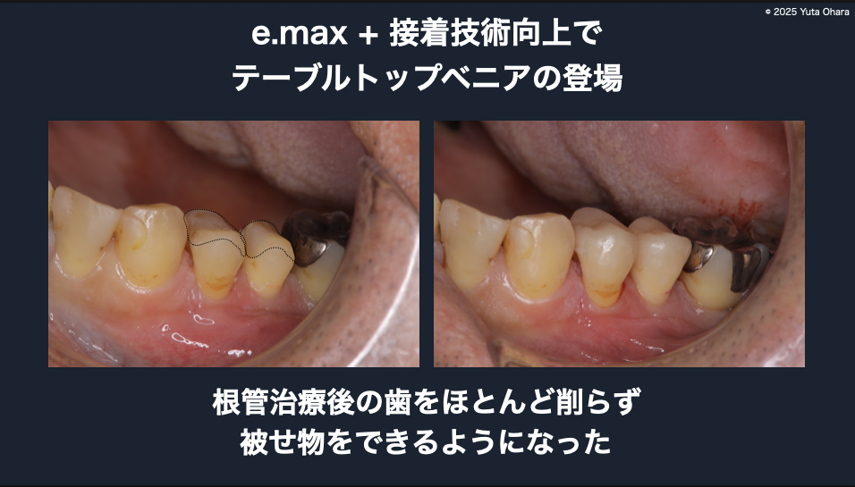 テーブルトップベニア