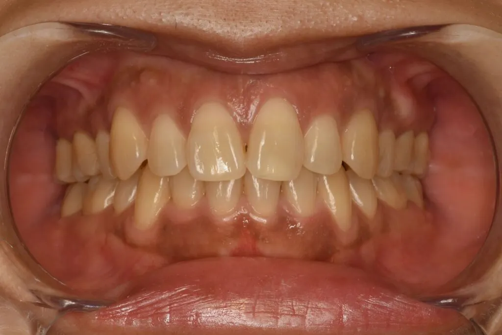 ガムピーリング1