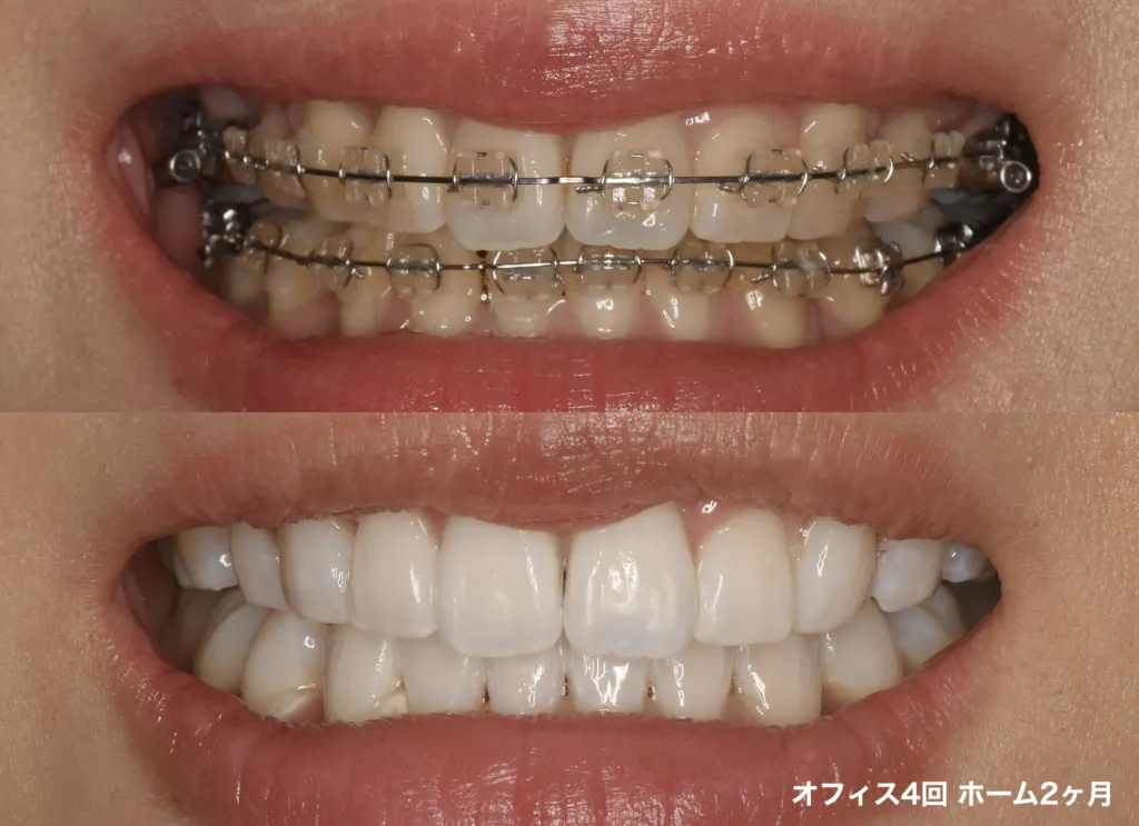 ボーテ式ホワイトニング