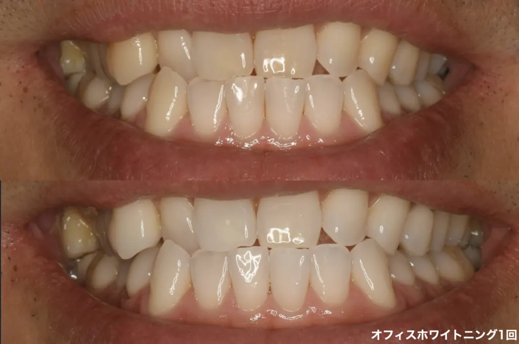 オフィスホワイトニング